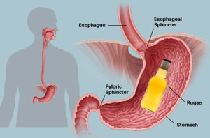 DUI stomach creating alcohol gut